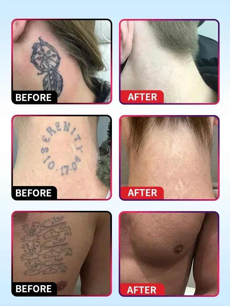 Tattoo Removal Essential Oil, Suitable for Large and Small Tattoos, Effectively Removes Permanent Tattoos